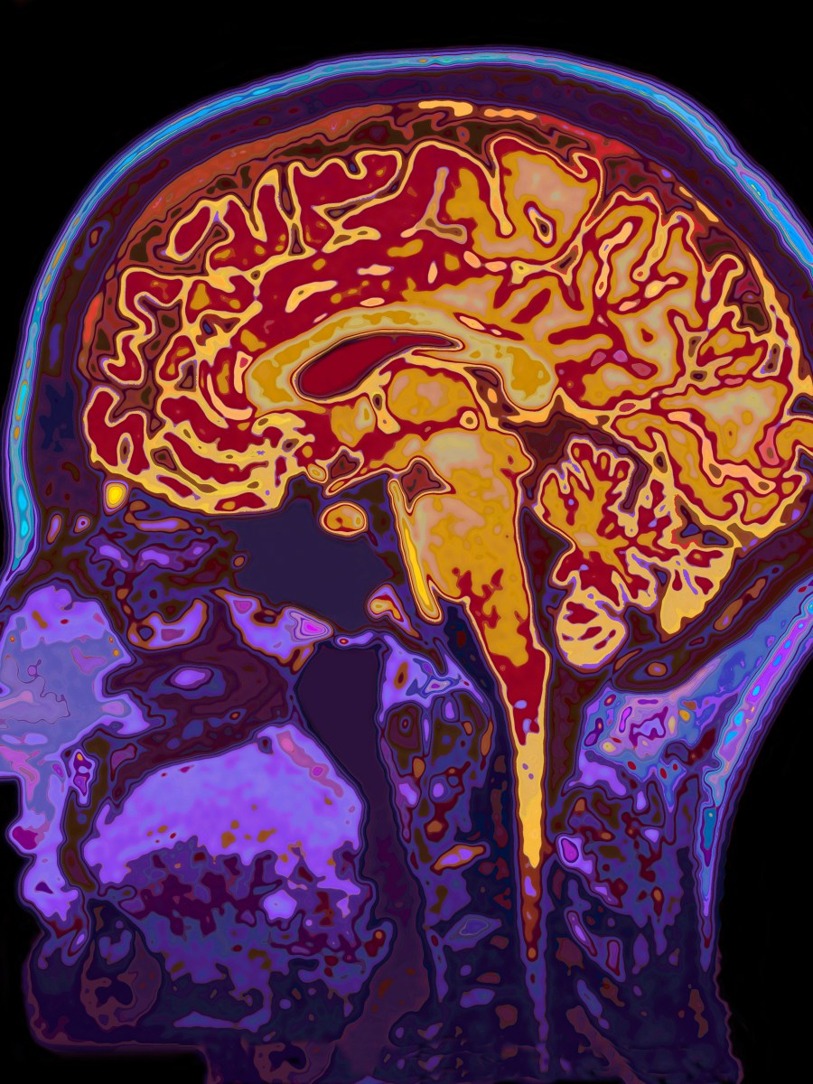 Brain Volume: Is Bigger Better?