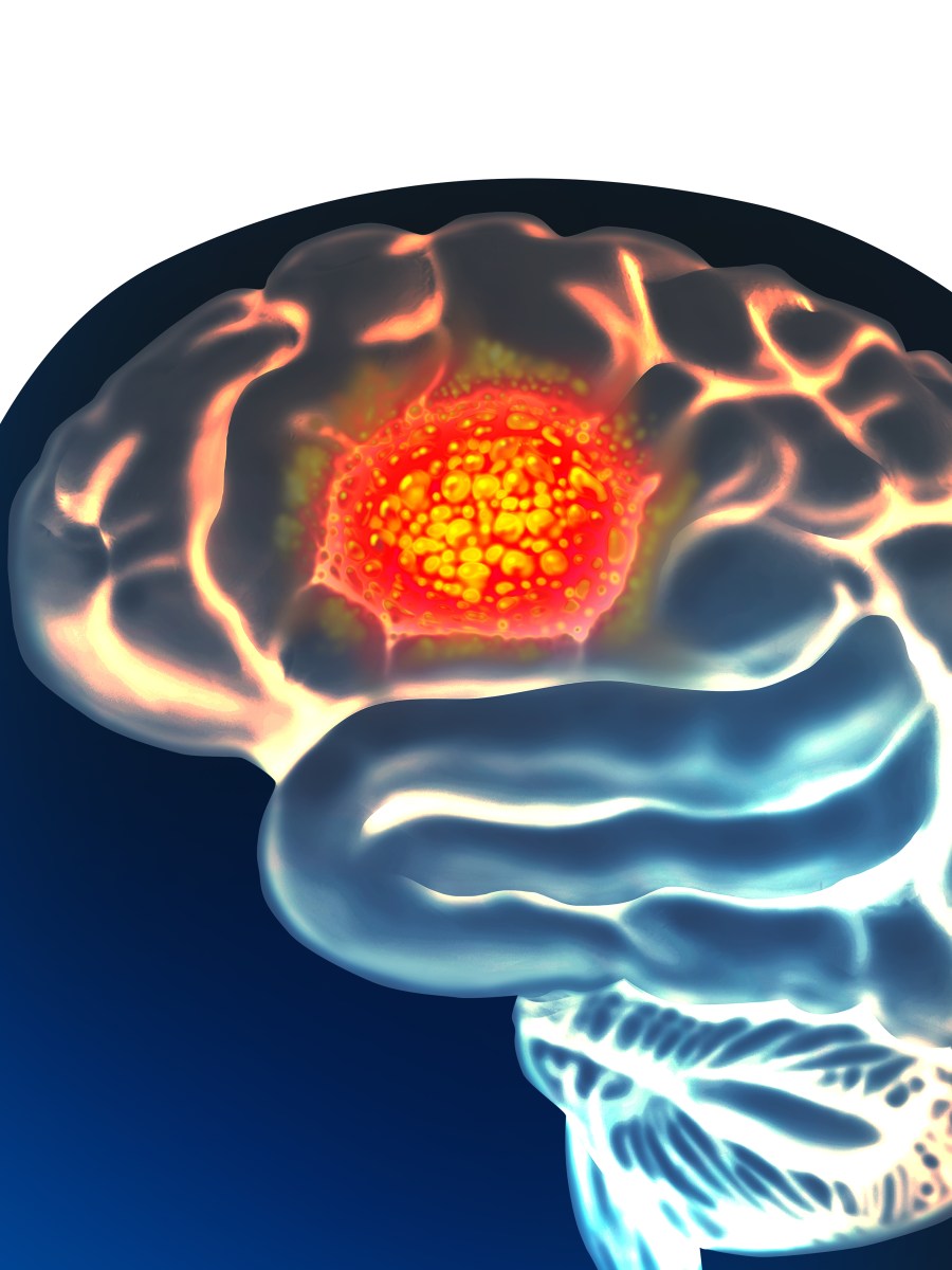 3D Bioprinting Strategies for Brain Cancer and the Blood Brain Barrier