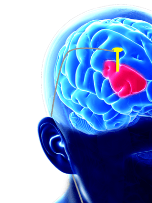 Deep Brain Stimulation (DBS): An Emerging Treatment For Mental Disorders